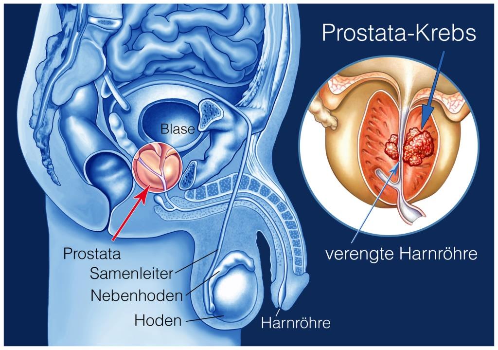 prostata gewebeveränderung)