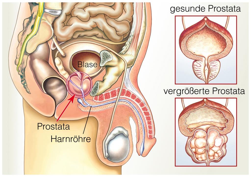 prostata knoten gutartig)